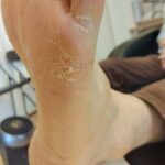 足の角質がある箇所をオルゴンで血流をよくしました。