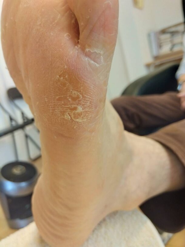 足の角質の写真